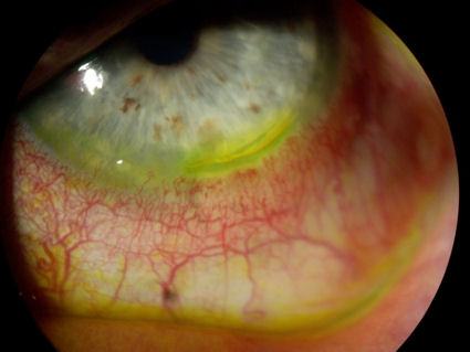 partially dislodged LASIK flap