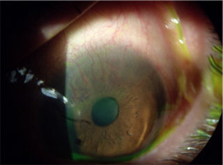 post lasik ectasia and corneal neovascularization