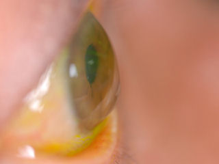 post-RK ectasia with corneal tissue protruding through RK incision