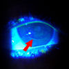 LASIK flap never heals