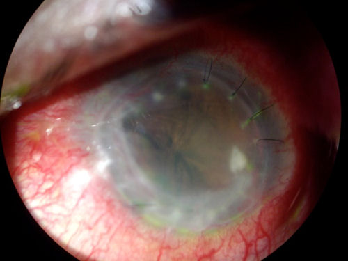 corneal transplant disaster1 jpg