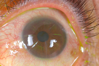 2 RK procedures followed by 2 LASIK surgeries