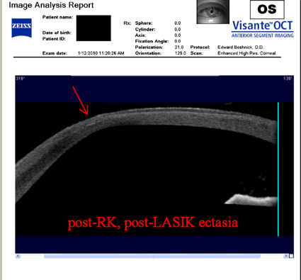 post-RK post-LASIK cornea with ectasia