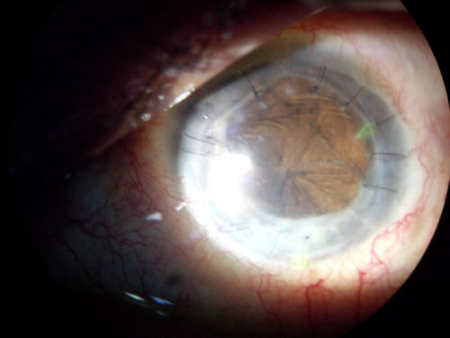 post transplant blind 500  jpg