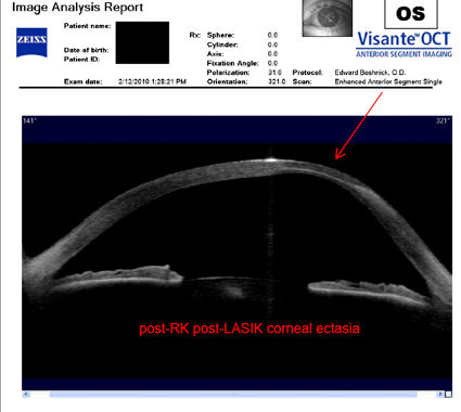 post-RK post-LASIK corneal ectasia