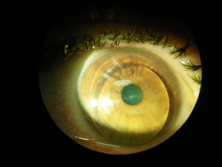 keratoconus with explanted Intac wearing lens