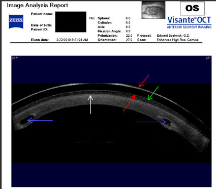Intacs implanted in a post LASIK cornea with ectasia