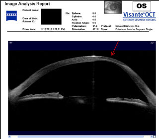 OCT scan of post-lasik ectasia