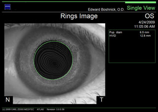 irregular astigmatism post lasik topography rings image