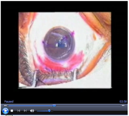 Lasik Lapses