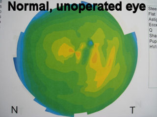 normal unoperated corneal topography