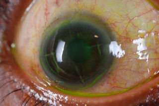 RK and LASIK
