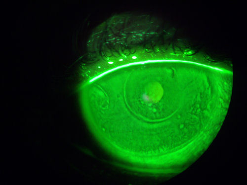 dry post-ALK cornea