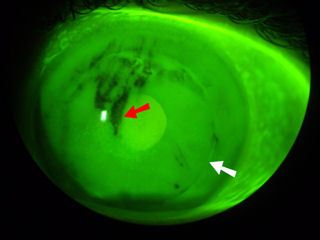 dry eye after LASIK