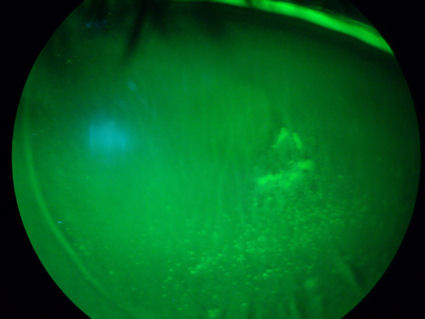 post-LASIK herpes simplex keratitis