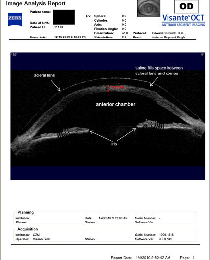 scleral lens on post-LASIK cornea