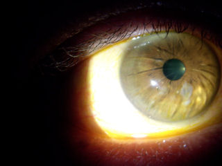 RK incisions