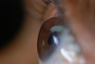 corneal ectasia after LASIK
