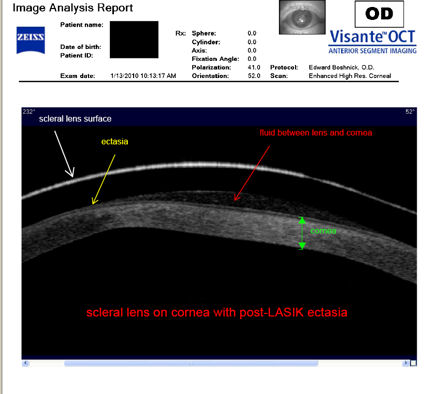 hard lens therapy for corneal ectasia after LASIK