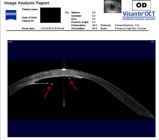 scan of post-LASIK ectasia with hydrops