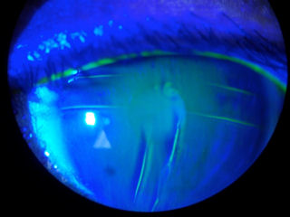 radial keratotomy 