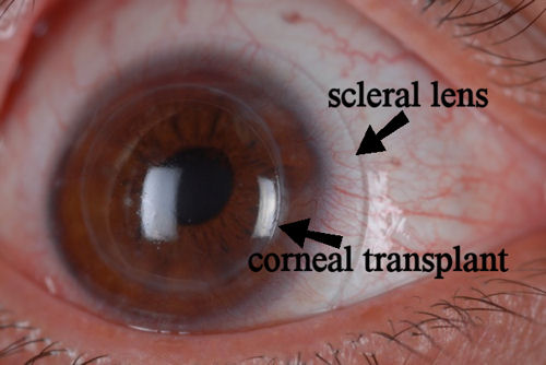 scleral lens over corneal transplant