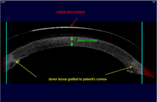 cornea of a patient with corneal transplant wearing scleral lens