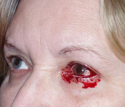 LASIK complications