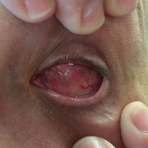 blind after LASIK