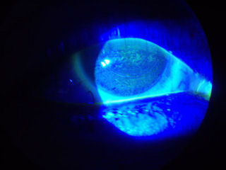 dry eye after LASIK